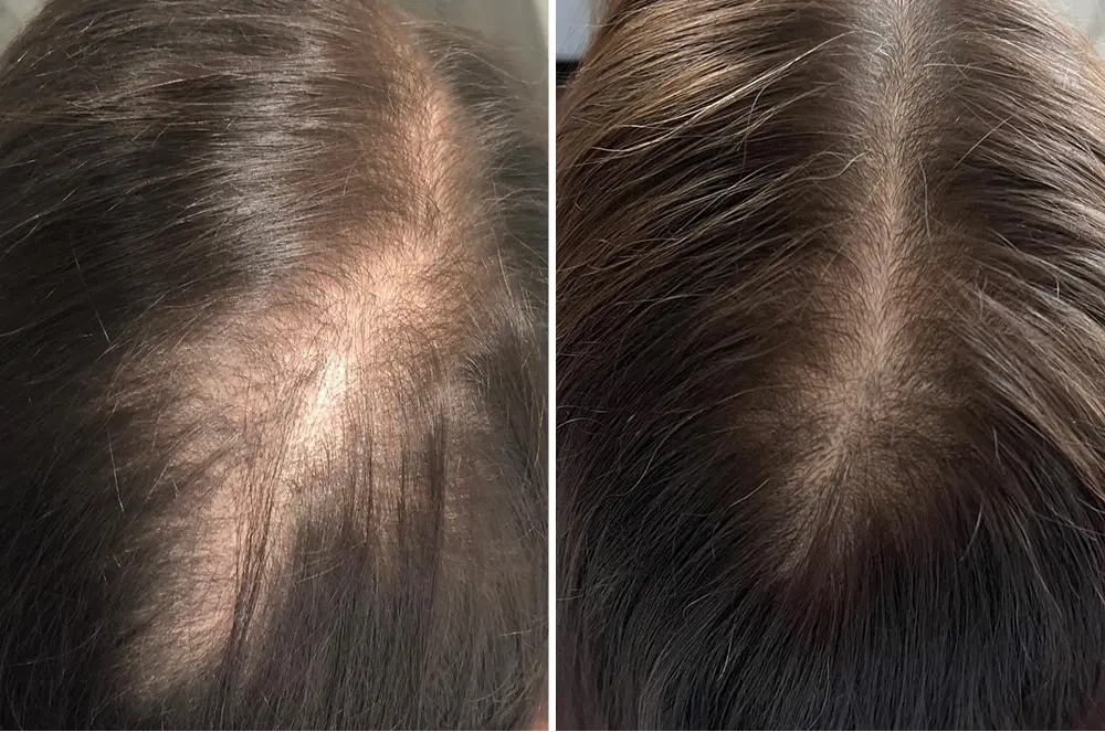 Karen S., 55 — crown, before and after 90 days