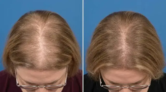 Marilyn T., 62 — part line, before and after 90 days